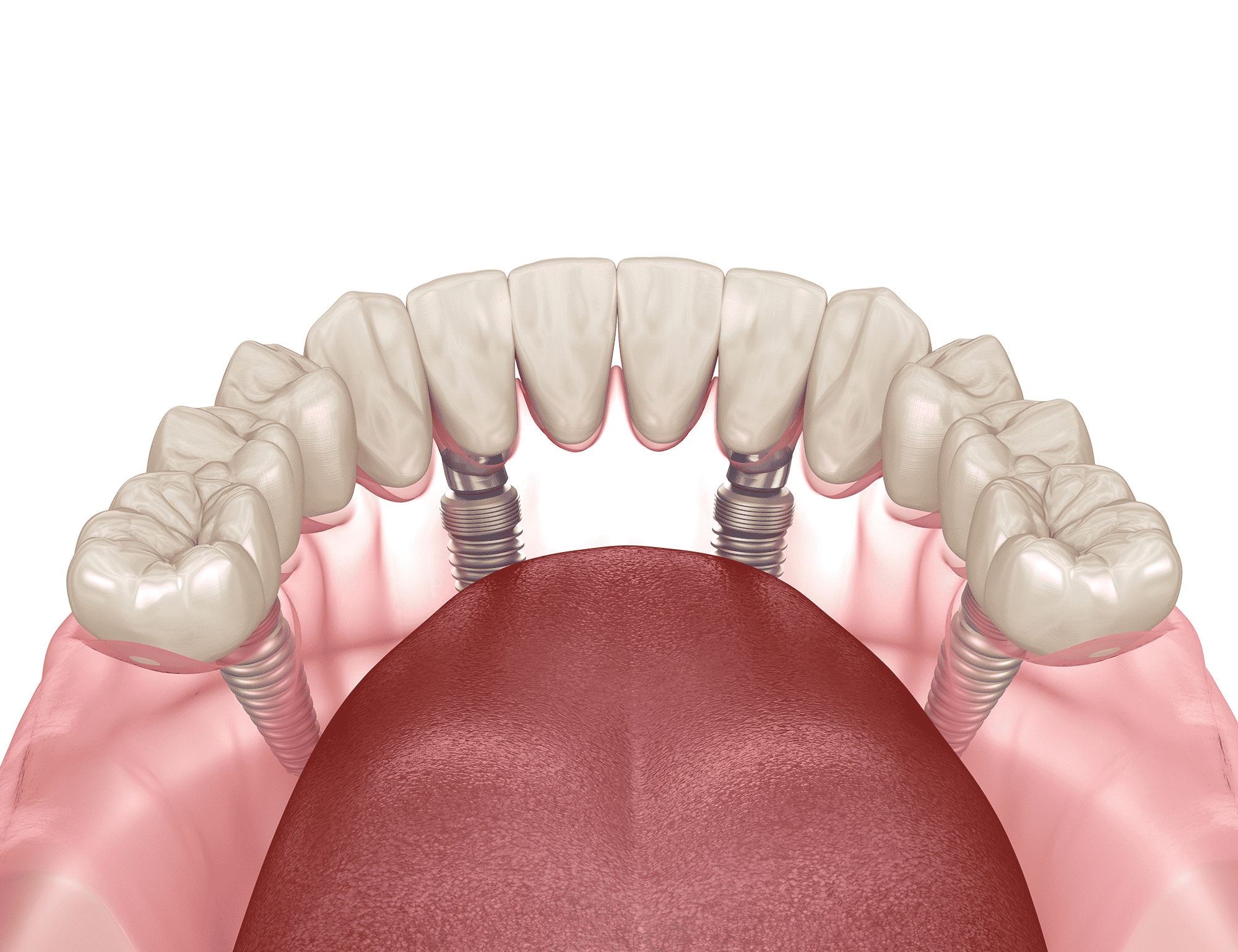 all on for dental implants implant horizon dental dentist in taylorsville utah Dr. Joshua Frandsen dds