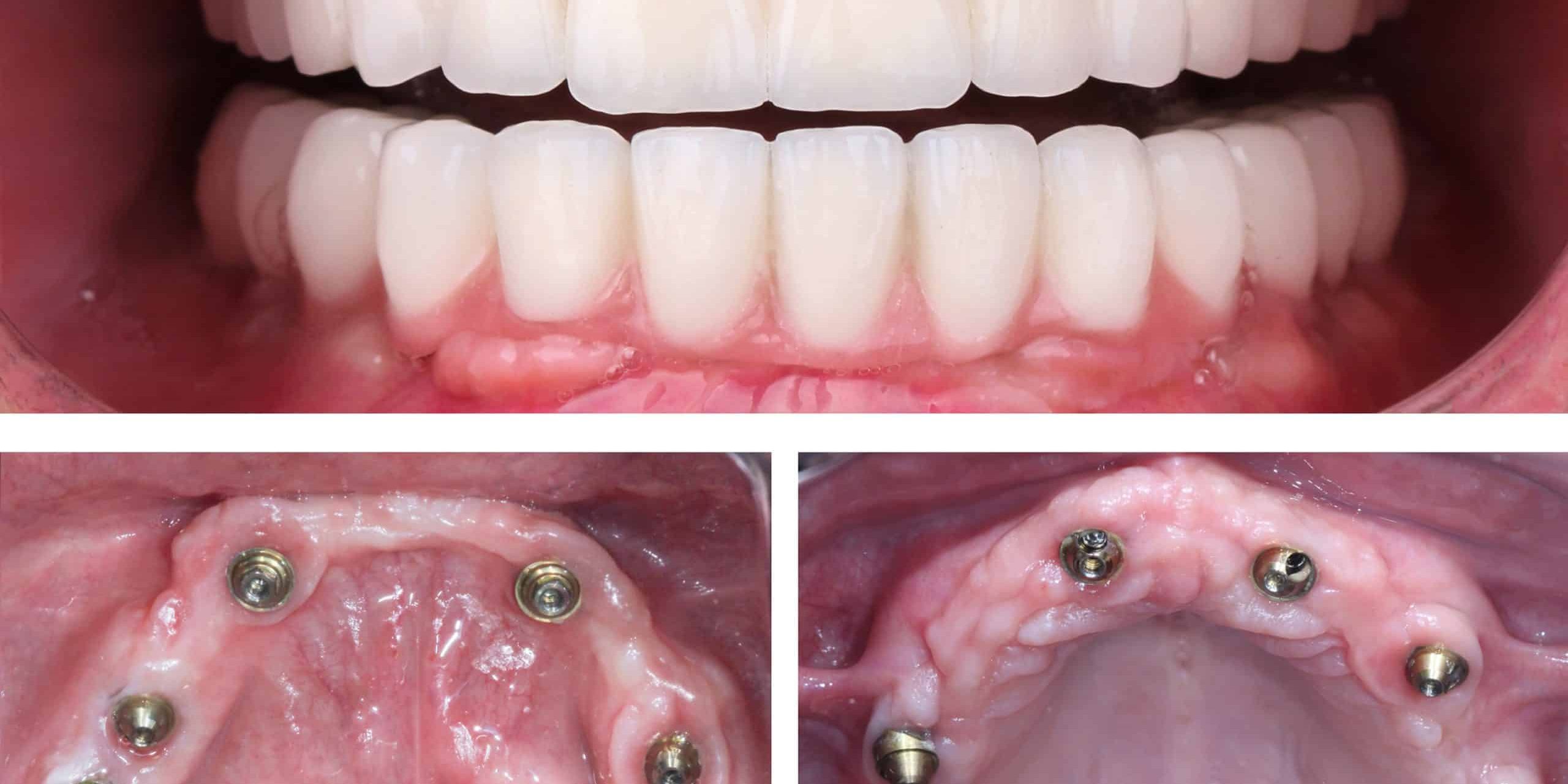 Full-arch,Dental,Prosthesis,For,Edentulous,Patients,Through,Jaw,Surgery,In implant dentistry taylorsville