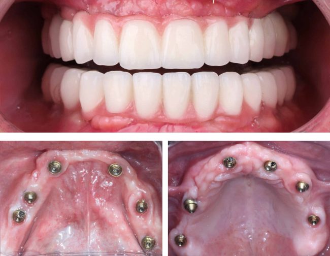 Full-arch,Dental,Prosthesis,For,Edentulous,Patients,Through,Jaw,Surgery,In implant dentistry taylorsville